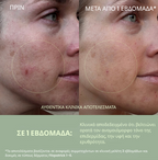 Biome-Balancing Calm & Recover Cream- Κρέμα για Ακμή